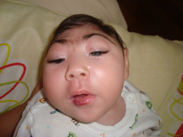 microcephalic child