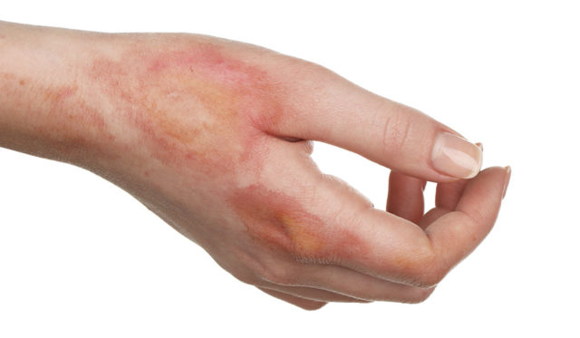 Home-Remedies-for-Minor-Burns